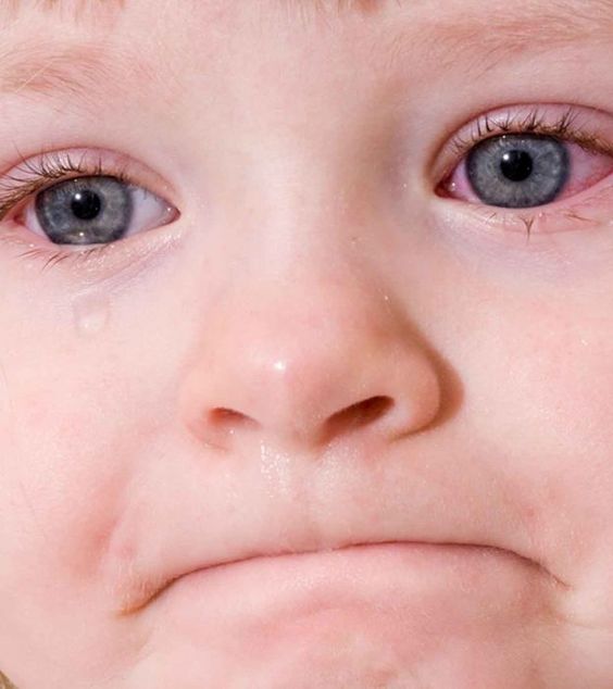 Pinkeye (conjonctivite) chez les bébés
