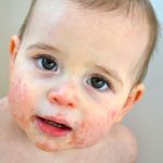 Eczéma chez les bébés et les enfants