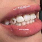 Are Tooth Gems Bad for Your Teeth