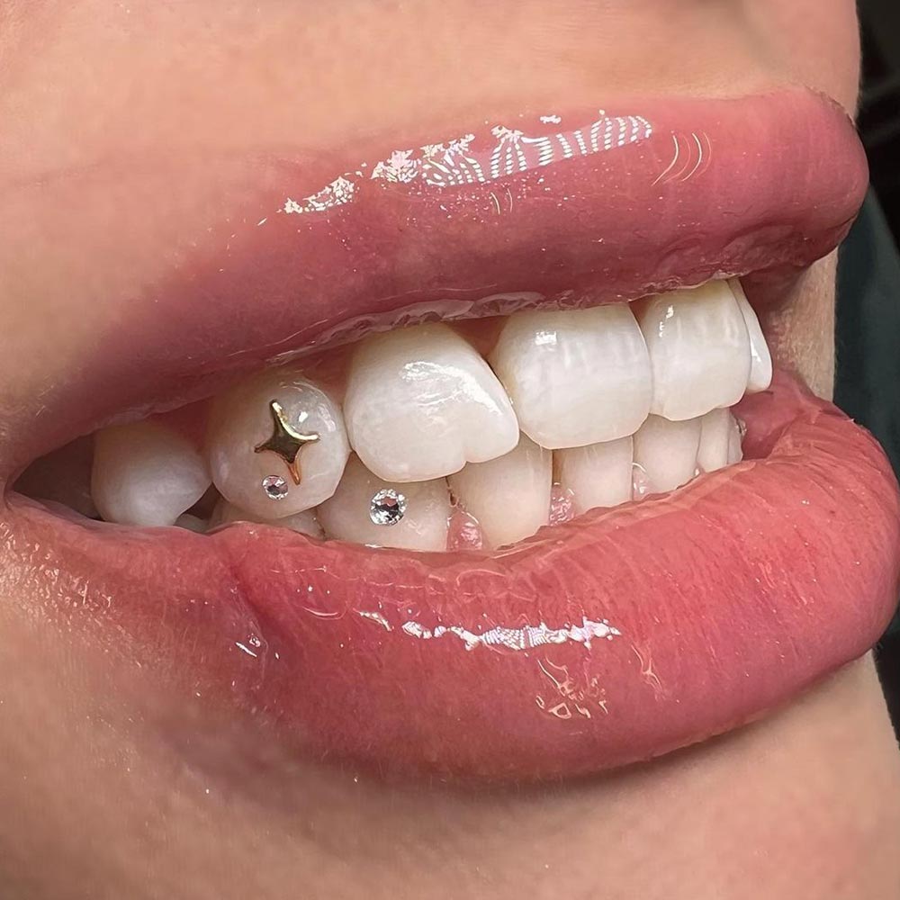 do tooth gems ruin your teeth